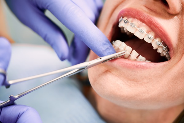 Braces Specialist: Your Path To Straighter Teeth