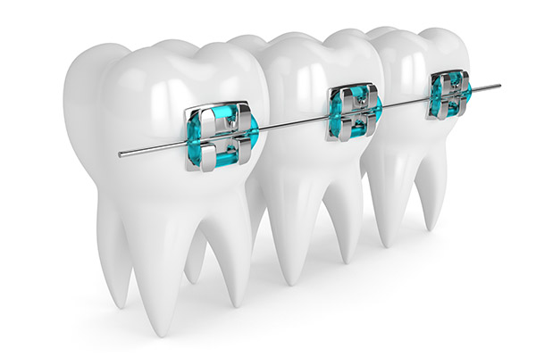 Orthodontic Options – Info on the Two Most Common Braces